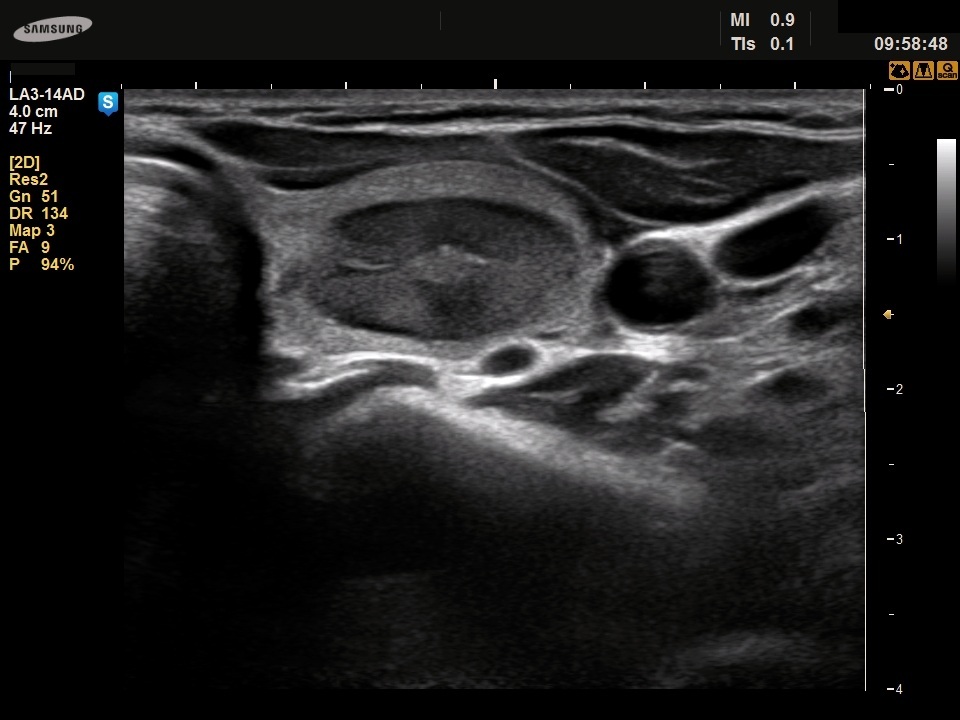 Right lobe, longitudinal scan
