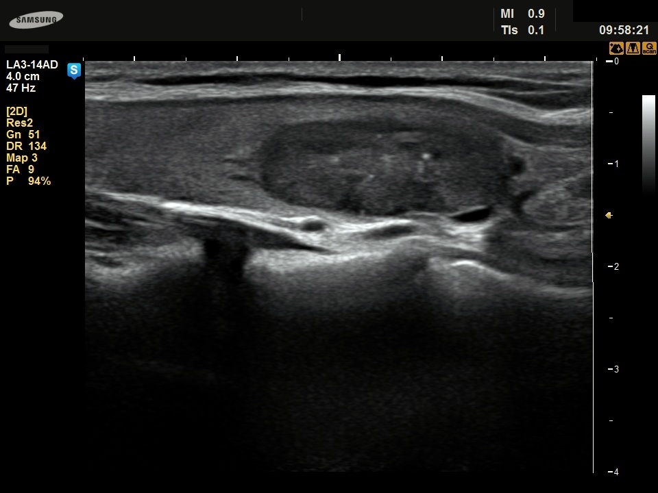 Right lobe, longitudinal scan