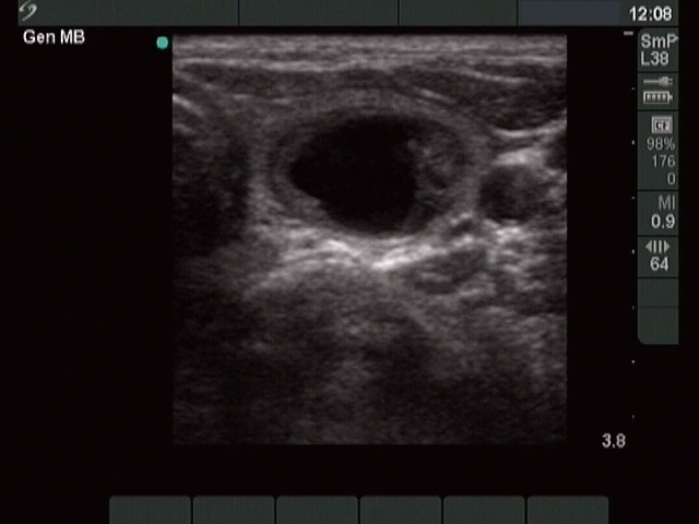 Right lobe, horizontal view