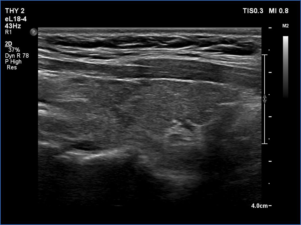 Right lobe, longitudinal scan