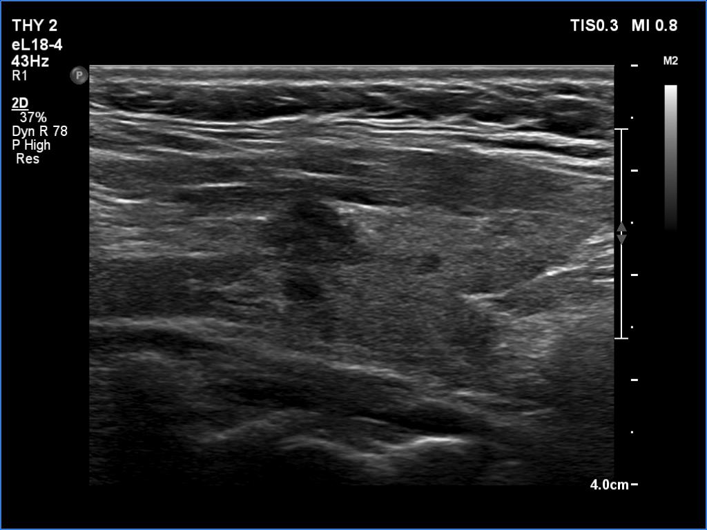Right lobe, longitudinal scan