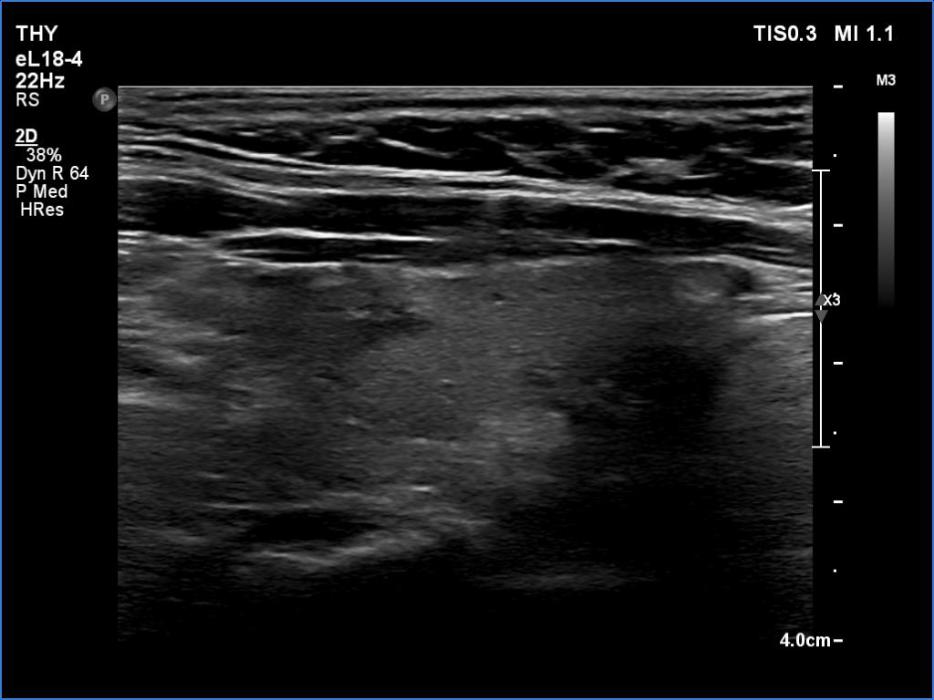 Right lobe, longitudinal scan