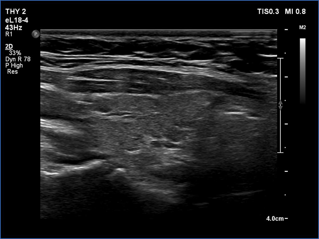 Right lobe, longitudinal scan