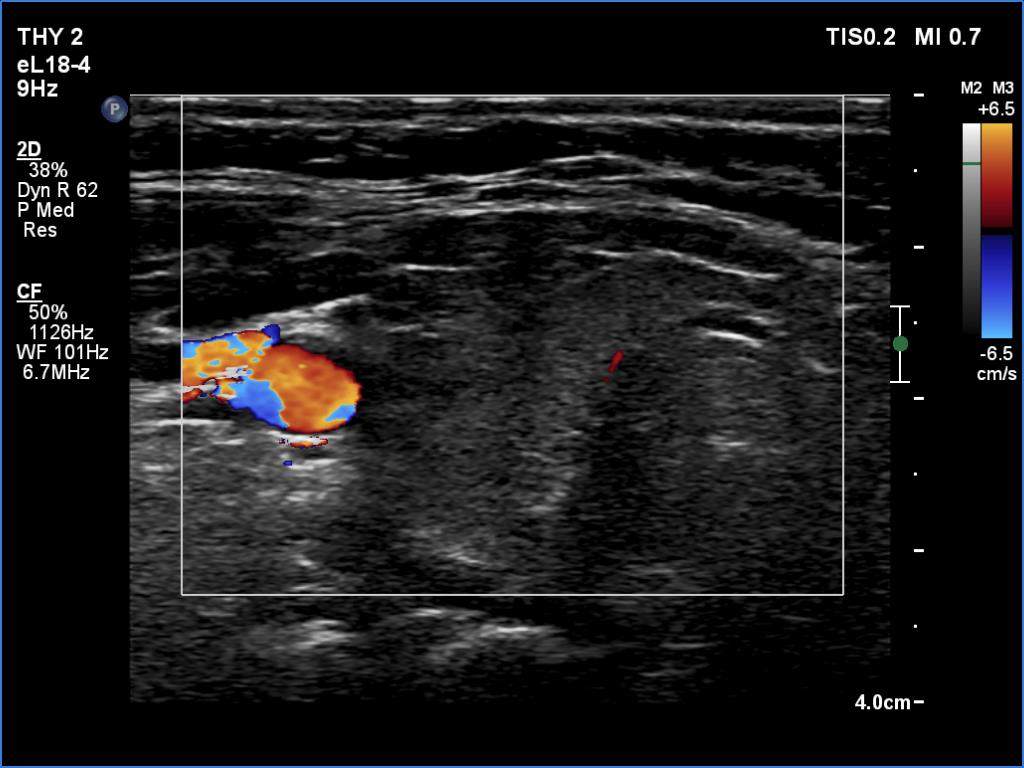 Right lobe, longitudinal scan