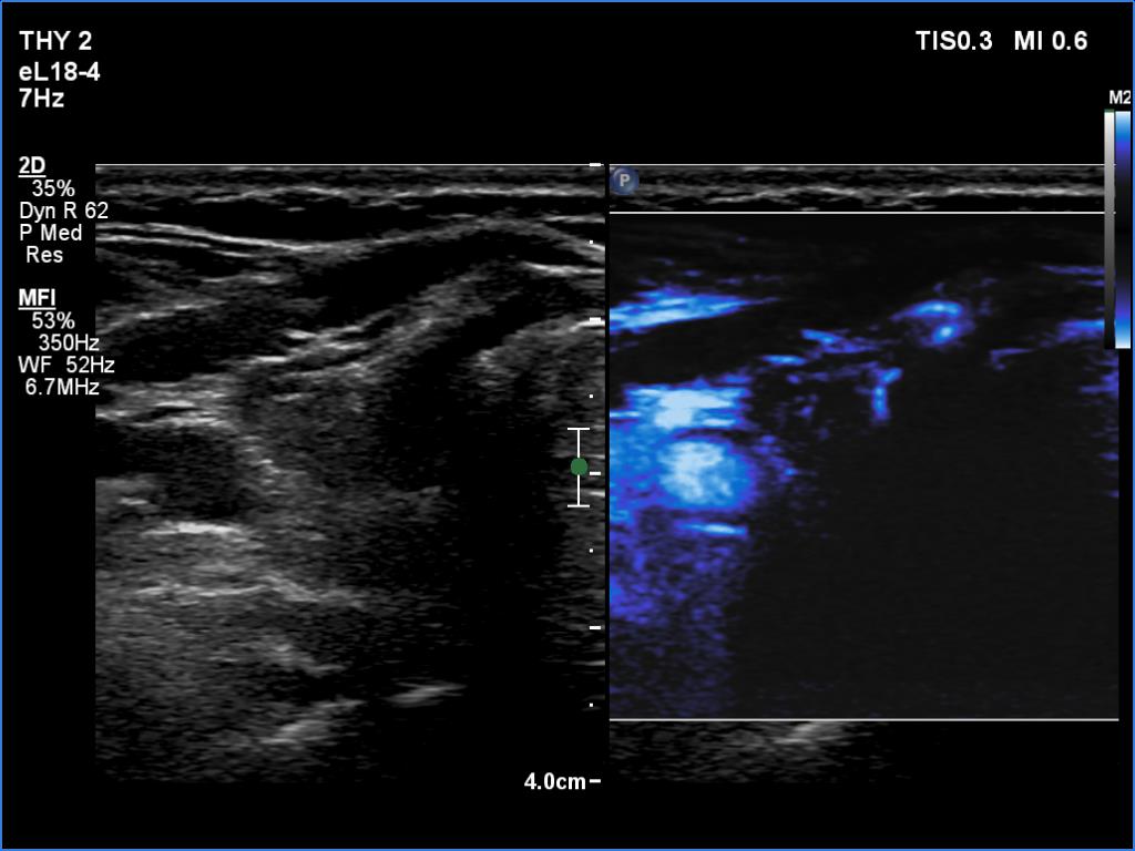 Right lobe, longitudinal scan