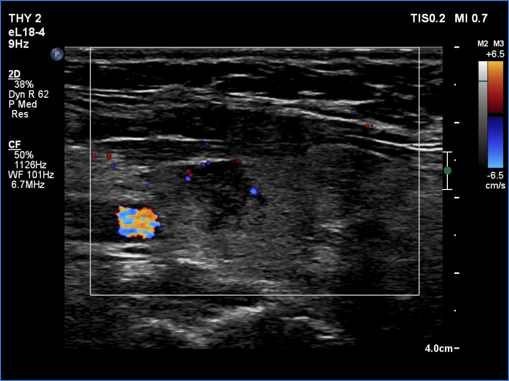 Right lobe, longitudinal scan