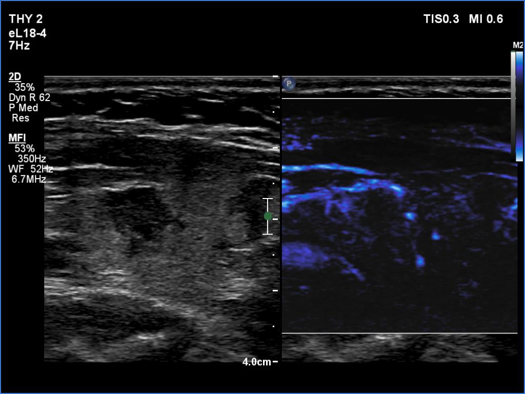 Right lobe, longitudinal scan