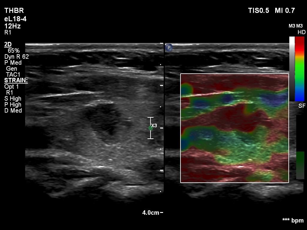 Right lobe, longitudinal scan