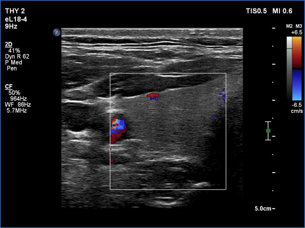 Right lobe, longitudinal scan
