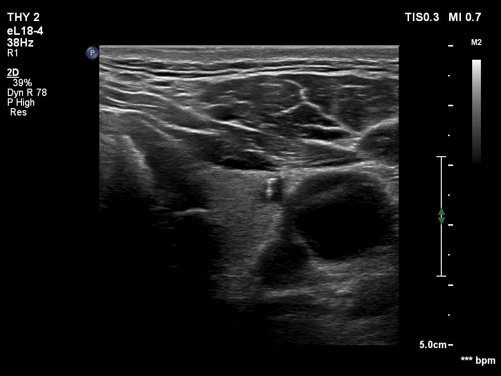 Right lobe, longitudinal scan