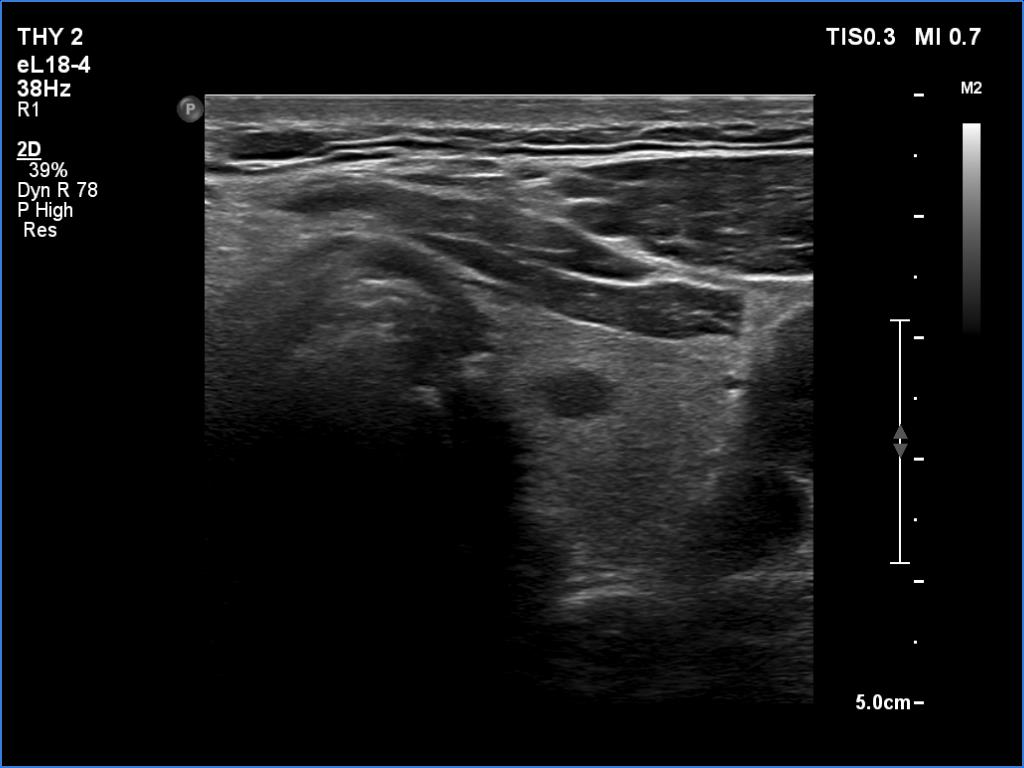 Right lobe, longitudinal scan