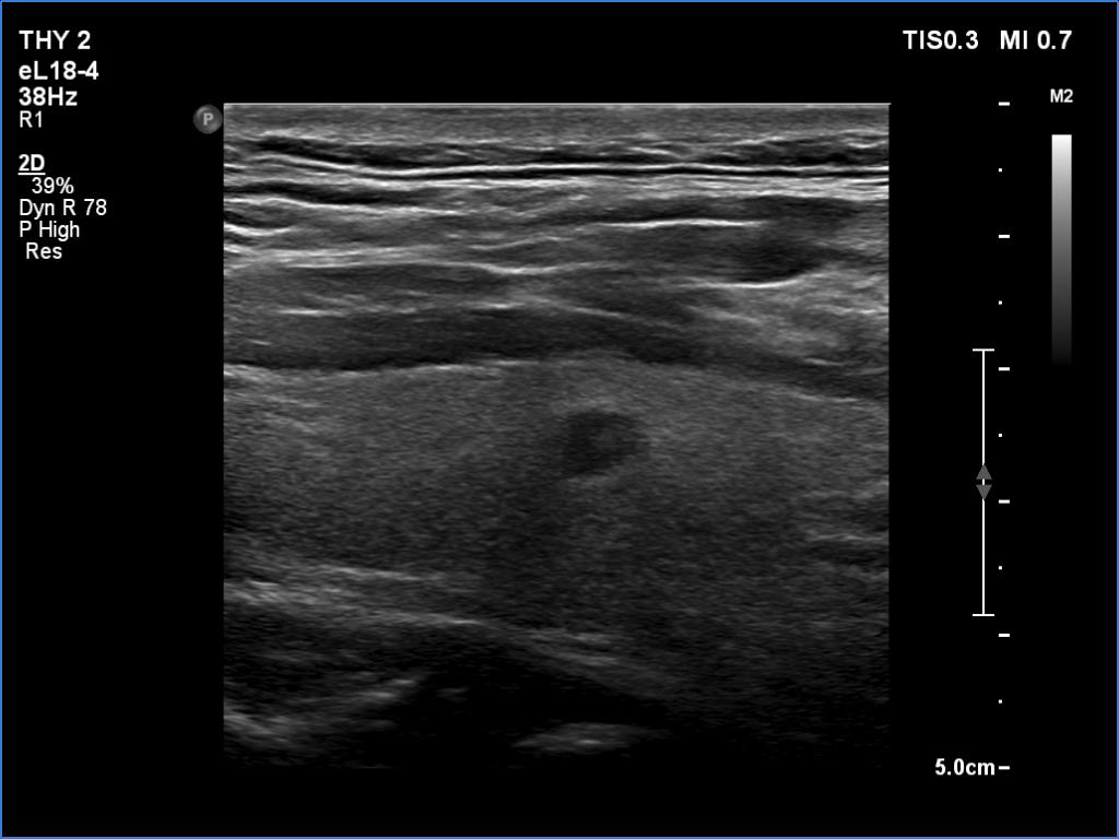 Right lobe, longitudinal scan