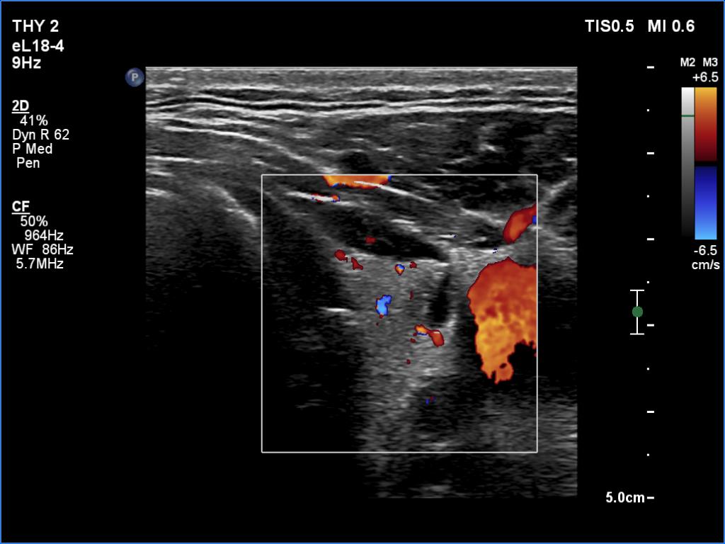 Right lobe, longitudinal scan