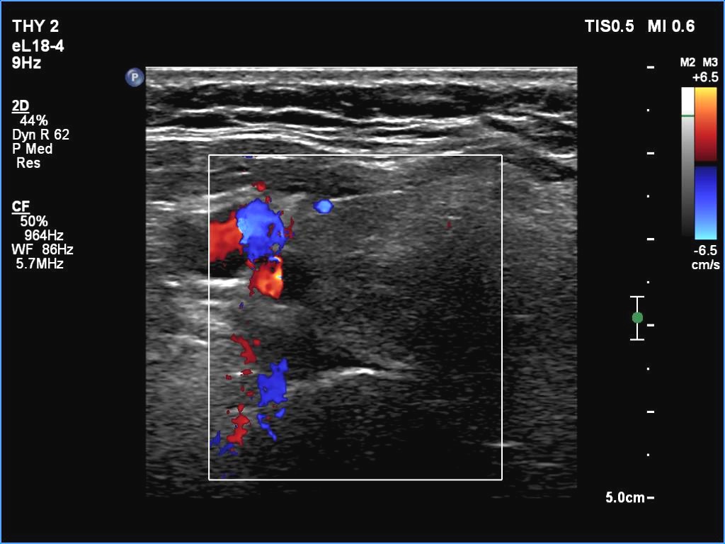 Right lobe, longitudinal scan