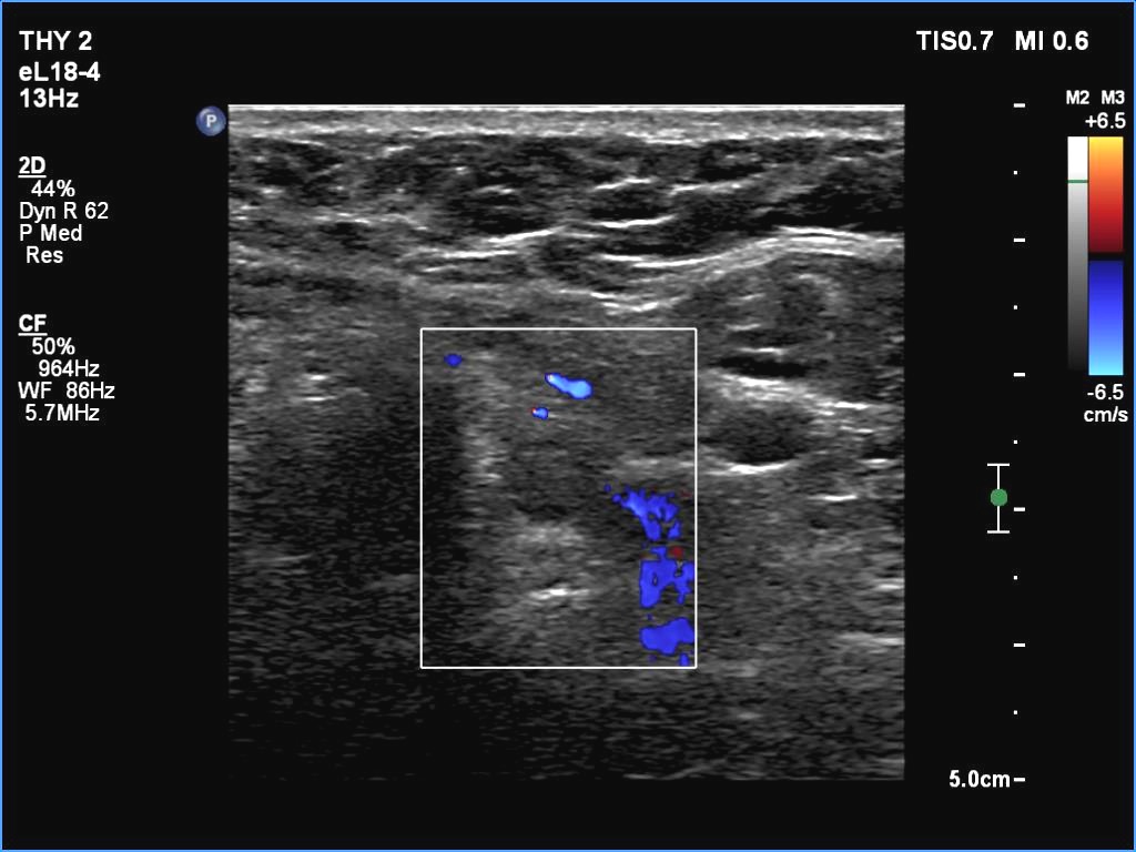 Right lobe, longitudinal scan