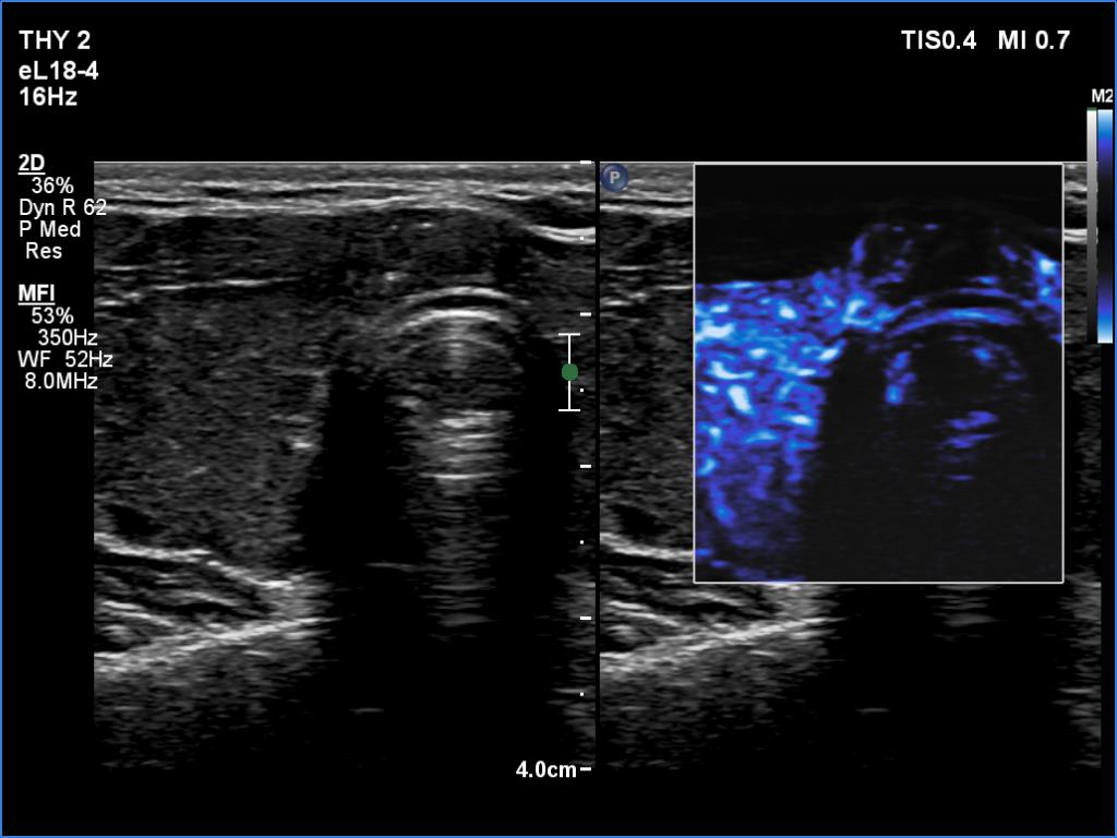 Right lobe, longitudinal scan