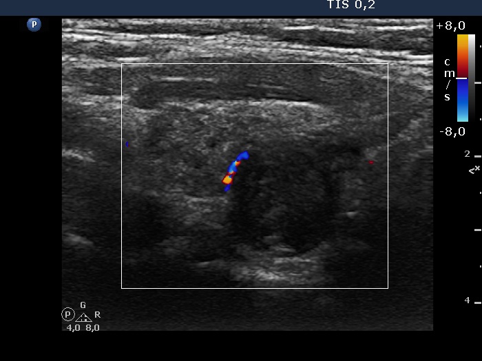 Right lobe, longitudinal scan