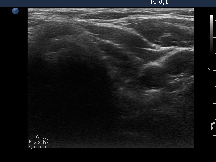 Right lobe, longitudinal scan