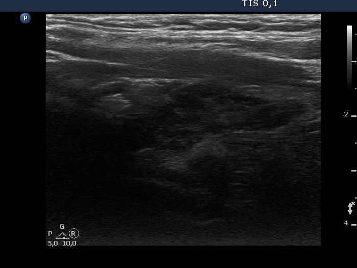 Right lobe, longitudinal scan