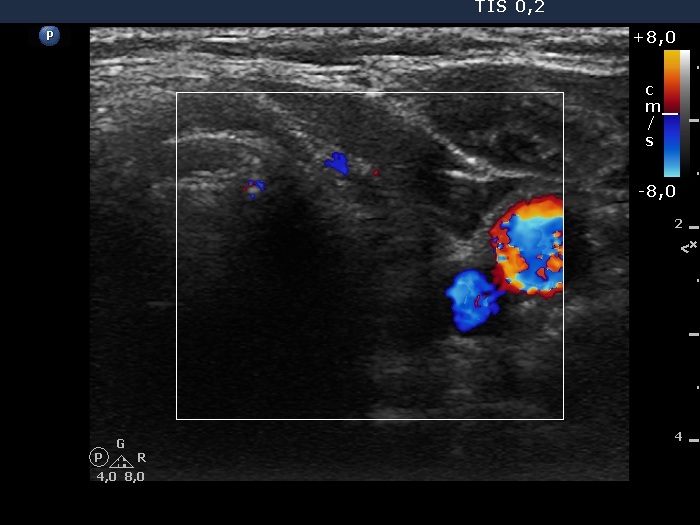 Right lobe, longitudinal scan