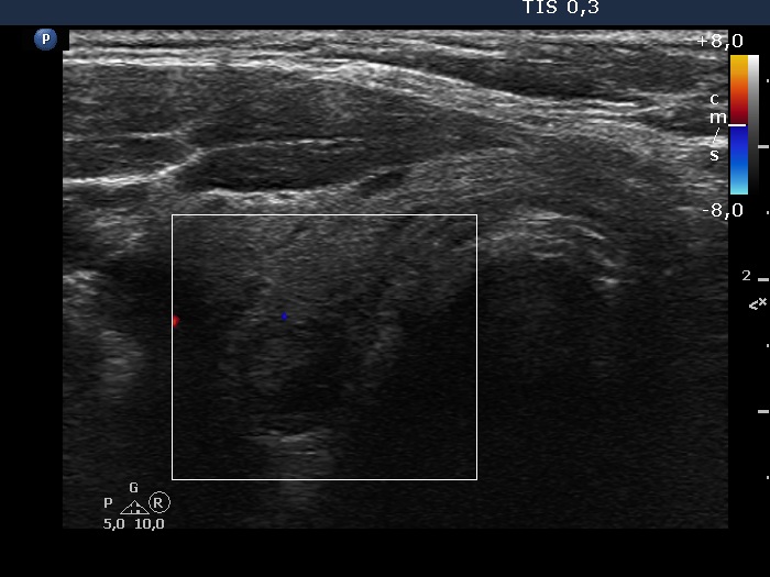 Right lobe, longitudinal scan