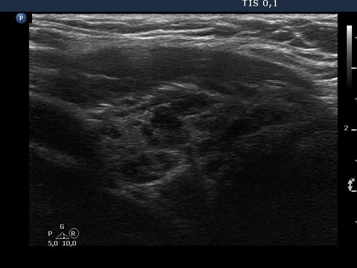 Right lobe, longitudinal scan