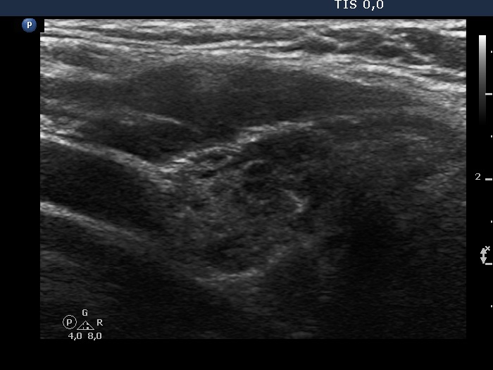 Right lobe, longitudinal scan