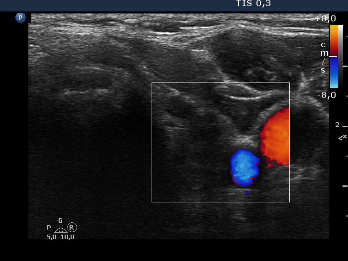 Right lobe, longitudinal scan