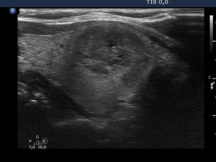 Right lobe, longitudinal scan