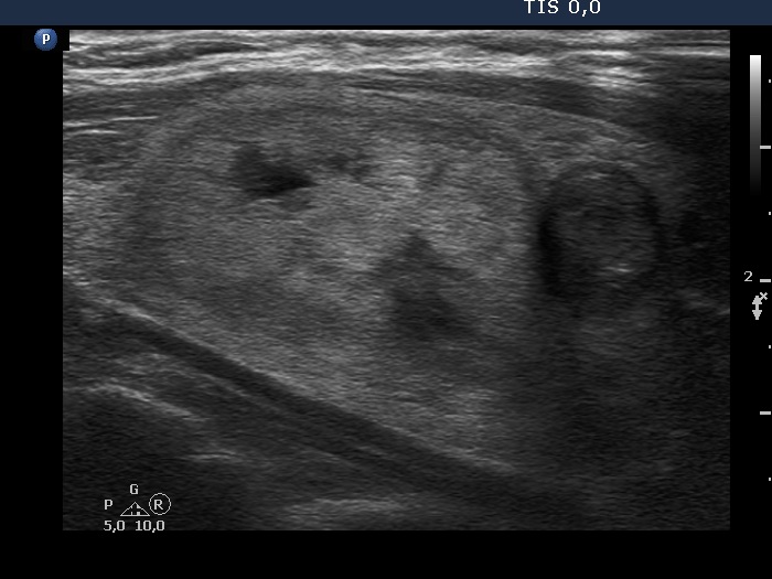 Right lobe, longitudinal scan