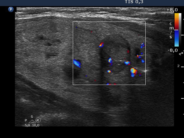 Right lobe, longitudinal scan