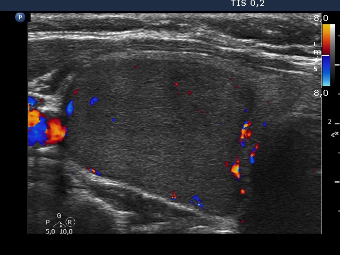 Right lobe, longitudinal scan