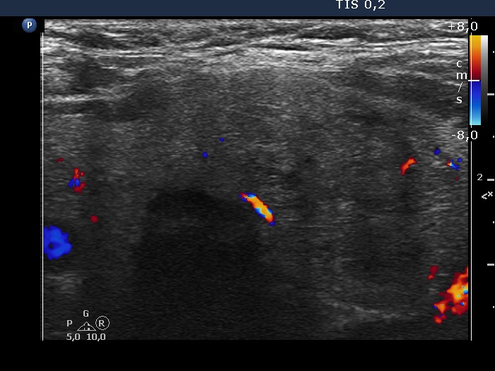 Right lobe, longitudinal scan
