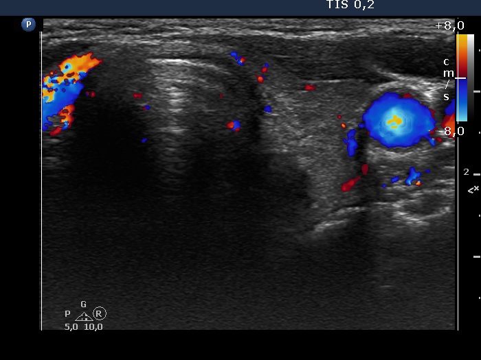 Right lobe, longitudinal scan