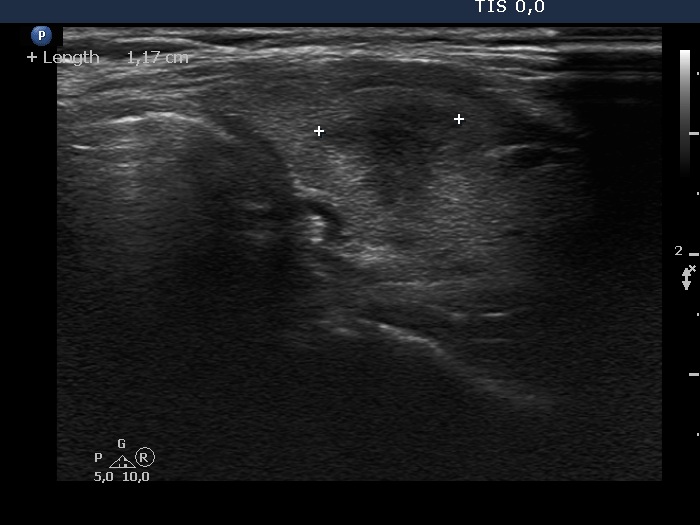 Right lobe, longitudinal scan