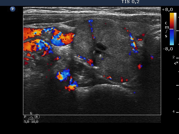 Right lobe, longitudinal scan