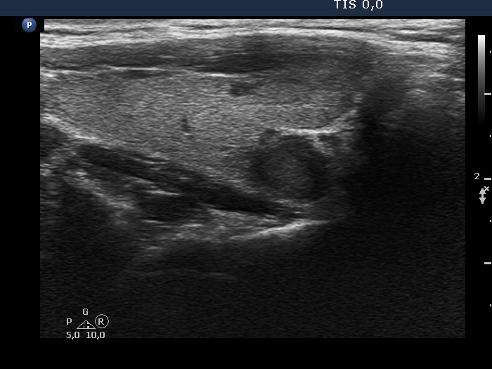 Right lobe, longitudinal scan