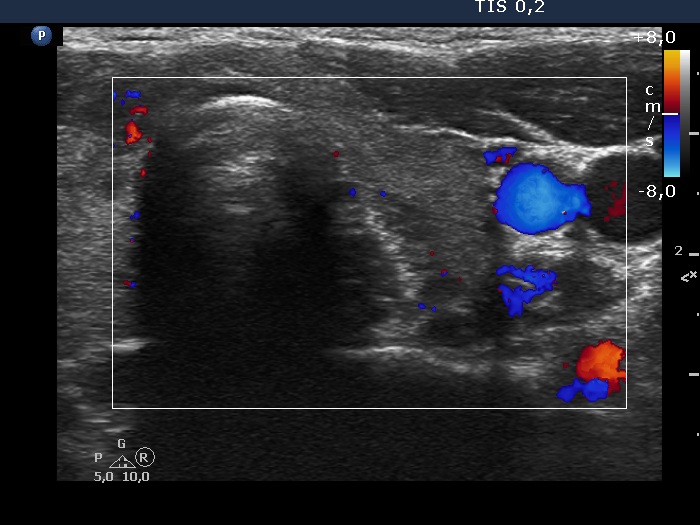 Right lobe, longitudinal scan