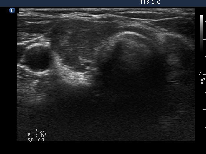 Right lobe, longitudinal scan