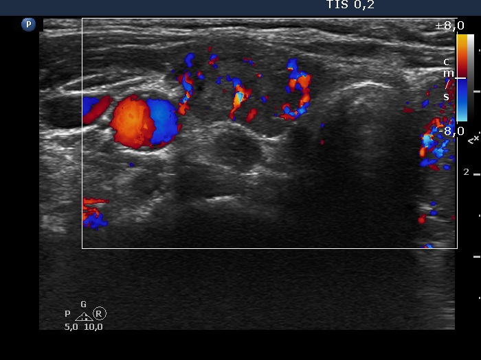 Right lobe, longitudinal scan