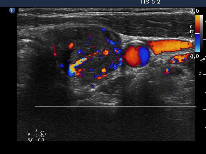 Right lobe, longitudinal scan