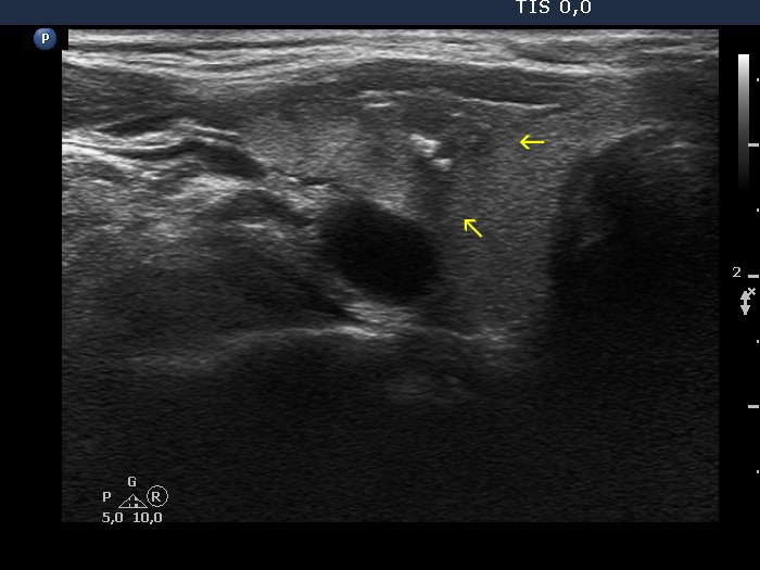 Right lobe, longitudinal scan