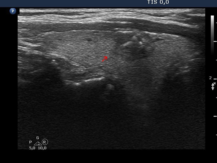 Right lobe, longitudinal scan