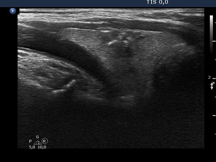 Right lobe, longitudinal scan
