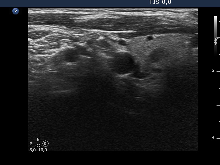 Right lobe, longitudinal scan