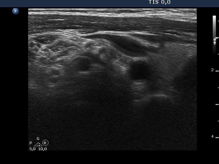 Right lobe, longitudinal scan