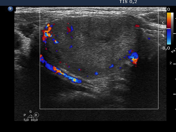 Right lobe, longitudinal scan
