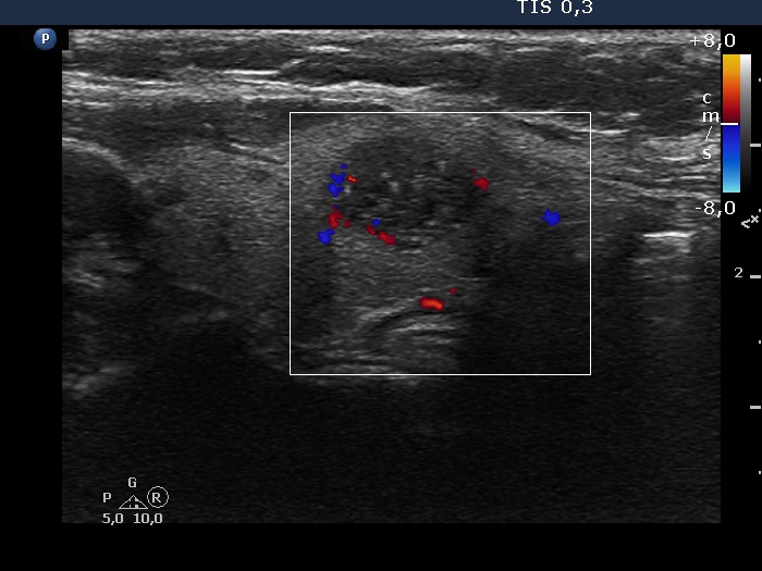 Right lobe, longitudinal scan