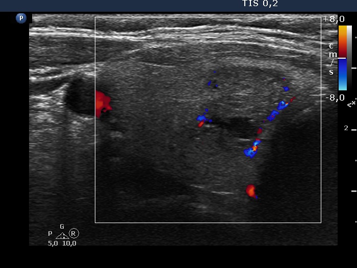 Right lobe, longitudinal scan