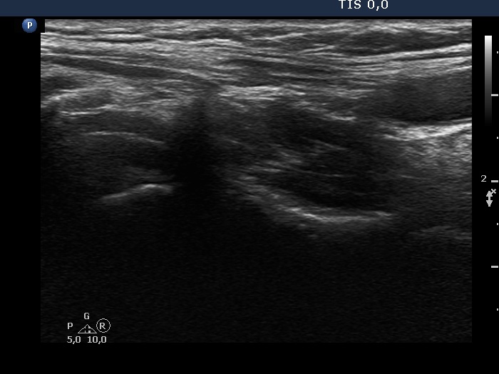 Right lobe, longitudinal scan